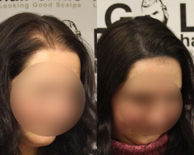 Scalp micropigmentation London Scalp micropigmentation London