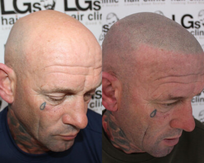 Scalp micropigmentation Birmingham Scalp micropigmentation Birmingham