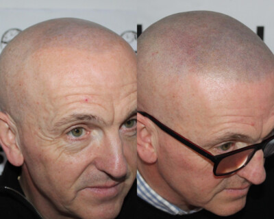 Hair tattooing Hair tattooing