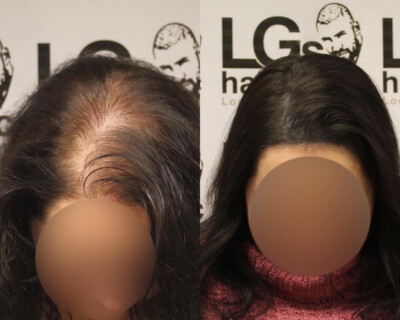 Scalp micropigmentation Birmingham Scalp micropigmentation Birmingham