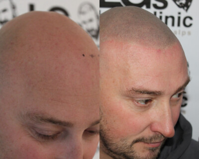 Scalp micropigmentation London Scalp micropigmentation London