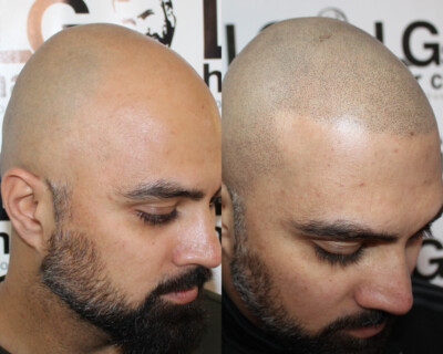 Scalp micropigmentation Birmingham Scalp micropigmentation Birmingham