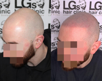 Hair tattooing Hair tattooing