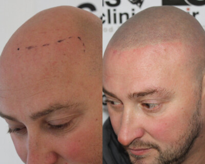 Scalp micropigmentation Birmingham Scalp micropigmentation Birmingham