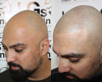 Scalp micropigmentation Scalp micropigmentation