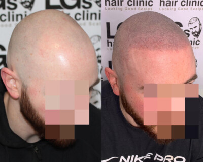 Scalp micropigmentation London Scalp micropigmentation London