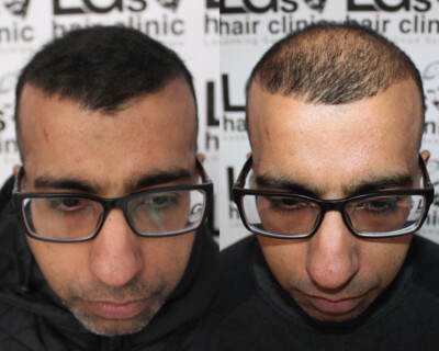 Scalp micropigmentation Birmingham Scalp micropigmentation Birmingham