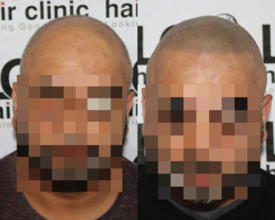 Scalp micropigmentation Scalp micropigmentation