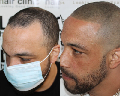 Scalp micropigmentation London Scalp micropigmentation London