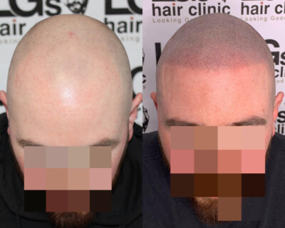 Scalp micropigmentation Birmingham Scalp micropigmentation Birmingham