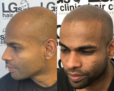 Hair tattooing Hair tattooing