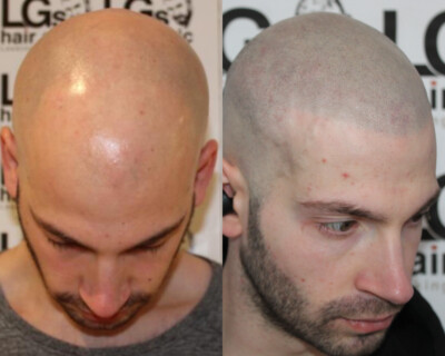 Scalp micropigmentation Birmingham Scalp micropigmentation Birmingham