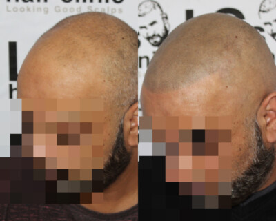 Scalp micropigmentation Scalp micropigmentation