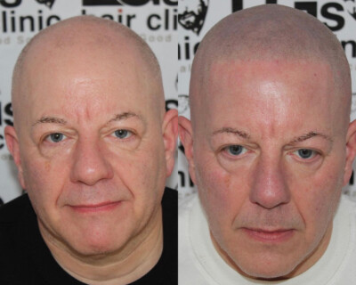 Scalp micropigmentation London Scalp micropigmentation London