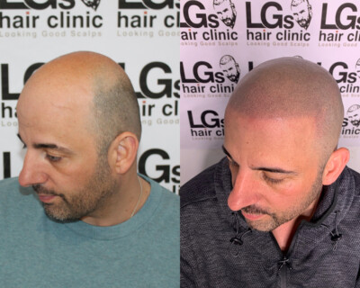 Scalp micropigmentation Scalp micropigmentation