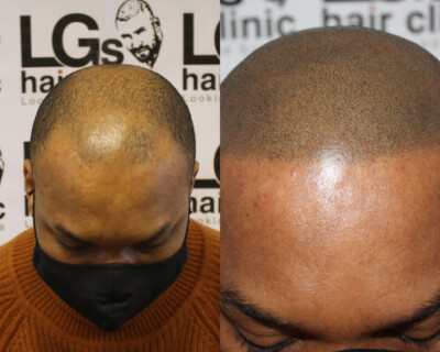 Scalp micropigmentation London Scalp micropigmentation London
