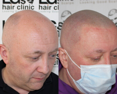 Hair tattooing Hair tattooing