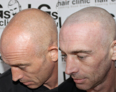 Scalp micropigmentation London Scalp micropigmentation London