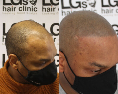 Scalp micropigmentation Birmingham Scalp micropigmentation Birmingham
