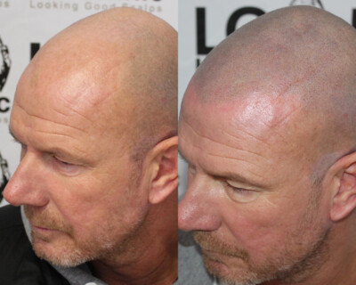Scalp micropigmentation Scalp micropigmentation