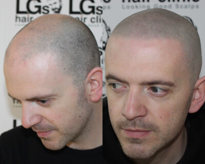 Scalp micropigmentation London Scalp micropigmentation London