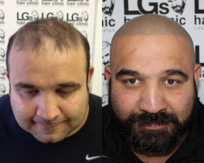 Scalp micropigmentation Birmingham Scalp micropigmentation Birmingham