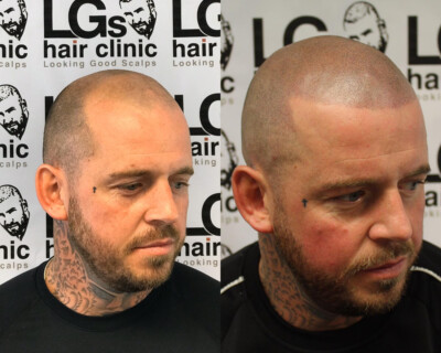 Scalp micropigmentation Scalp micropigmentation