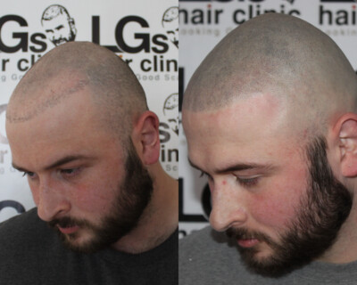 Scalp micropigmentation Scalp micropigmentation