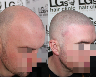 Hair tattooing Hair tattooing