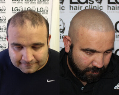 Scalp micropigmentation Birmingham Scalp micropigmentation Birmingham