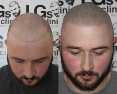 Scalp micropigmentation Scalp micropigmentation