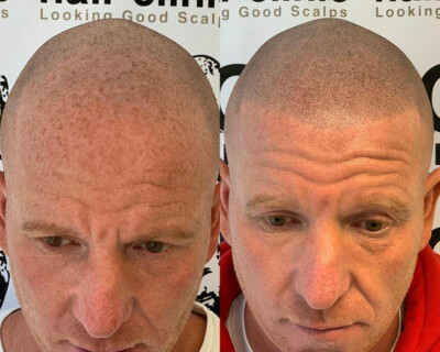 hairline lowering birmingham hairline lowering birmingham