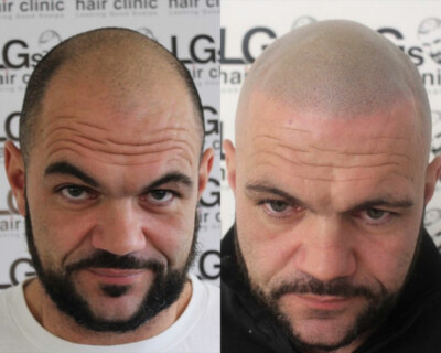 mens hairline tattoo birmingham mens hairline tattoo birmingham