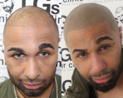 scalp micropigmentation results uk scalp micropigmentation results uk