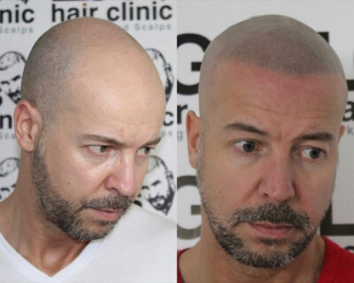 hairline correction hairline correction