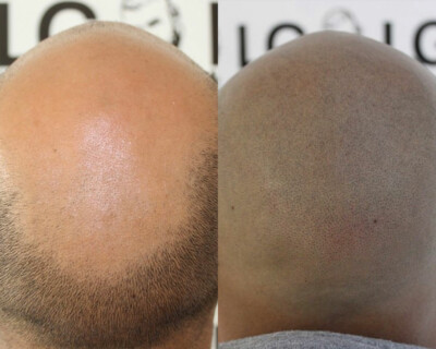scalp micropigmentation birmingham scalp micropigmentation birmingham