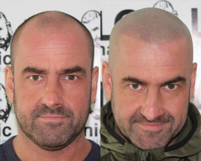 hairline correction services uk hairline correction services uk