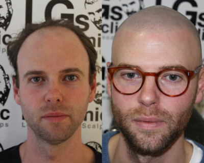 hairline lowering cost hairline lowering cost