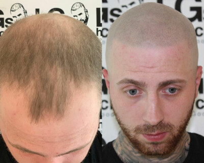 hairline tattoo results difference hairline tattoo results difference