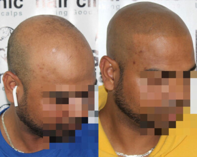 hair clinic jewellery quarter hair clinic jewellery quarter