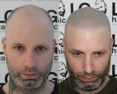 hairline lowering london hairline lowering london