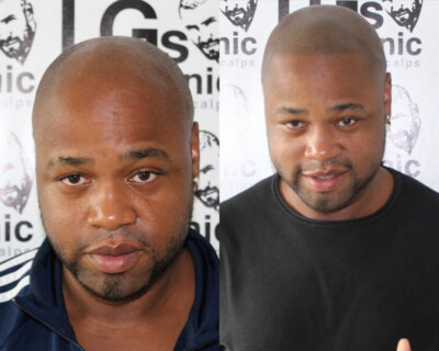 mens hairline tattoo clinic mens hairline tattoo clinic