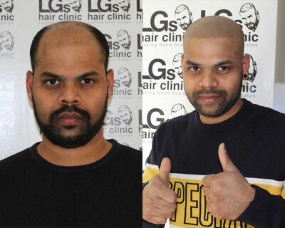 hair tattoo before and after hair tattoo before and after