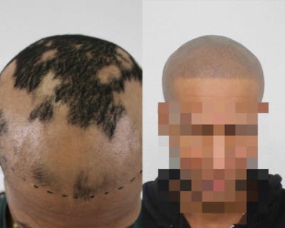best scalp micropigmentation clinic birmingham best scalp micropigmentation clinic birmingham