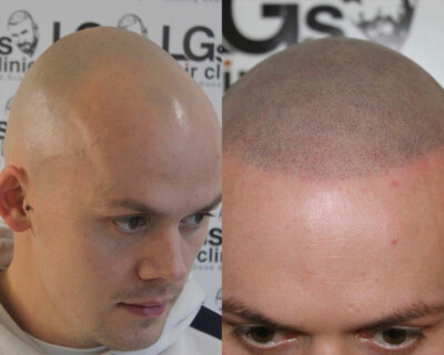 best scalp micropigmentation clinic uk best scalp micropigmentation clinic uk