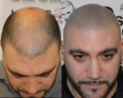 hairline lowering birmingham hairline lowering birmingham