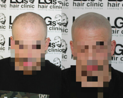 hairline lowering london hairline lowering london