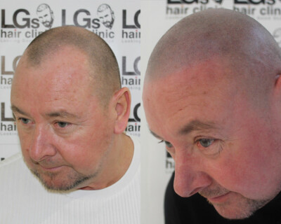 best smp clinic birmingham best smp clinic birmingham